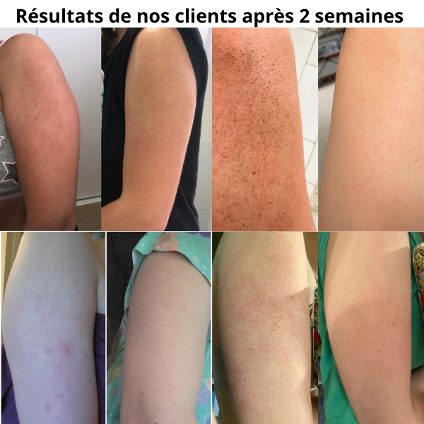 CURVEA | Triple Acide | Peau Lisse et Confiance retrouvée