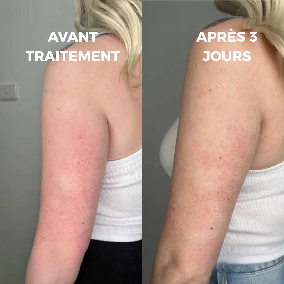 CURVEA | Triple Acide | Peau Lisse et Confiance retrouvée